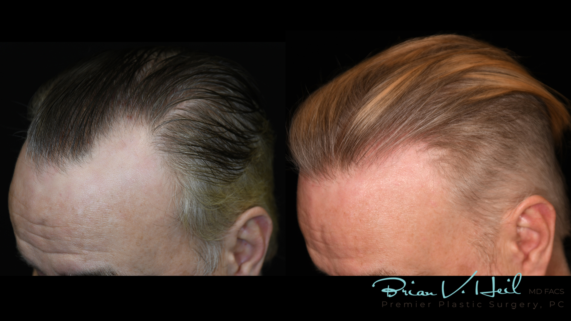 Hair Restoration Before and After | Premier Plastic Surgery