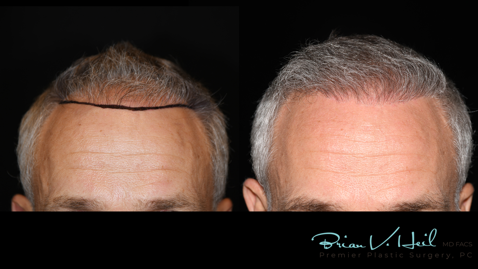 Hair Restoration Before and After | Premier Plastic Surgery