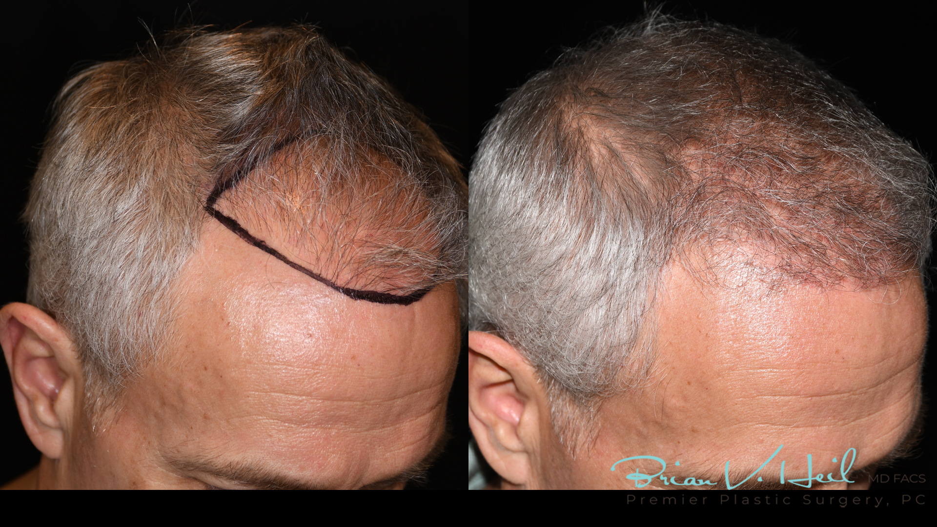 Hair Restoration Before and After | Premier Plastic Surgery