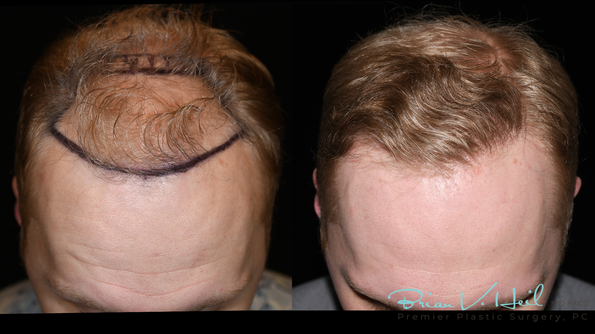 Hair Restoration Before and After | Premier Plastic Surgery