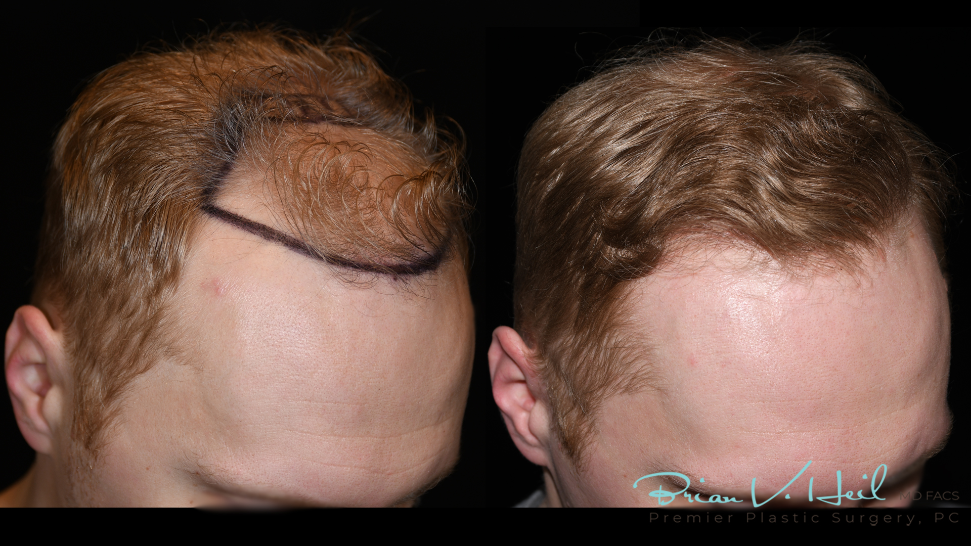 Hair Restoration Before and After | Premier Plastic Surgery