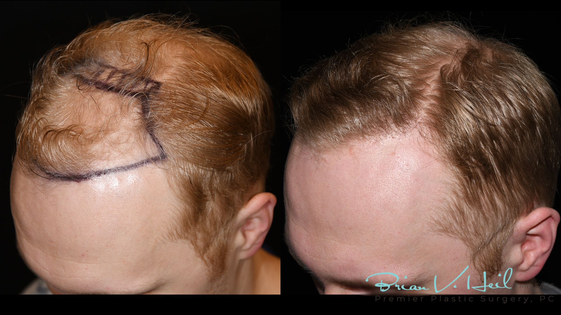 Hair Restoration Before and After | Premier Plastic Surgery