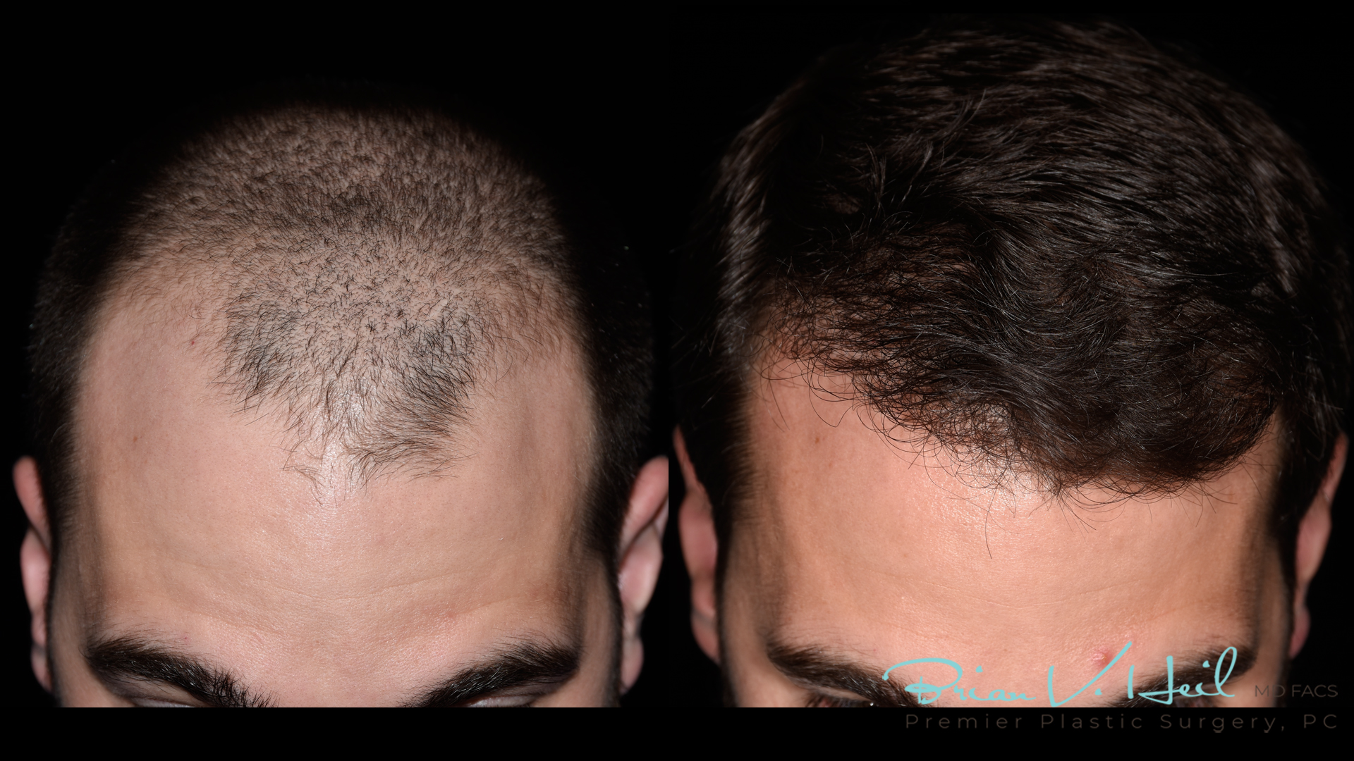 Hair Restoration Before and After | Premier Plastic Surgery