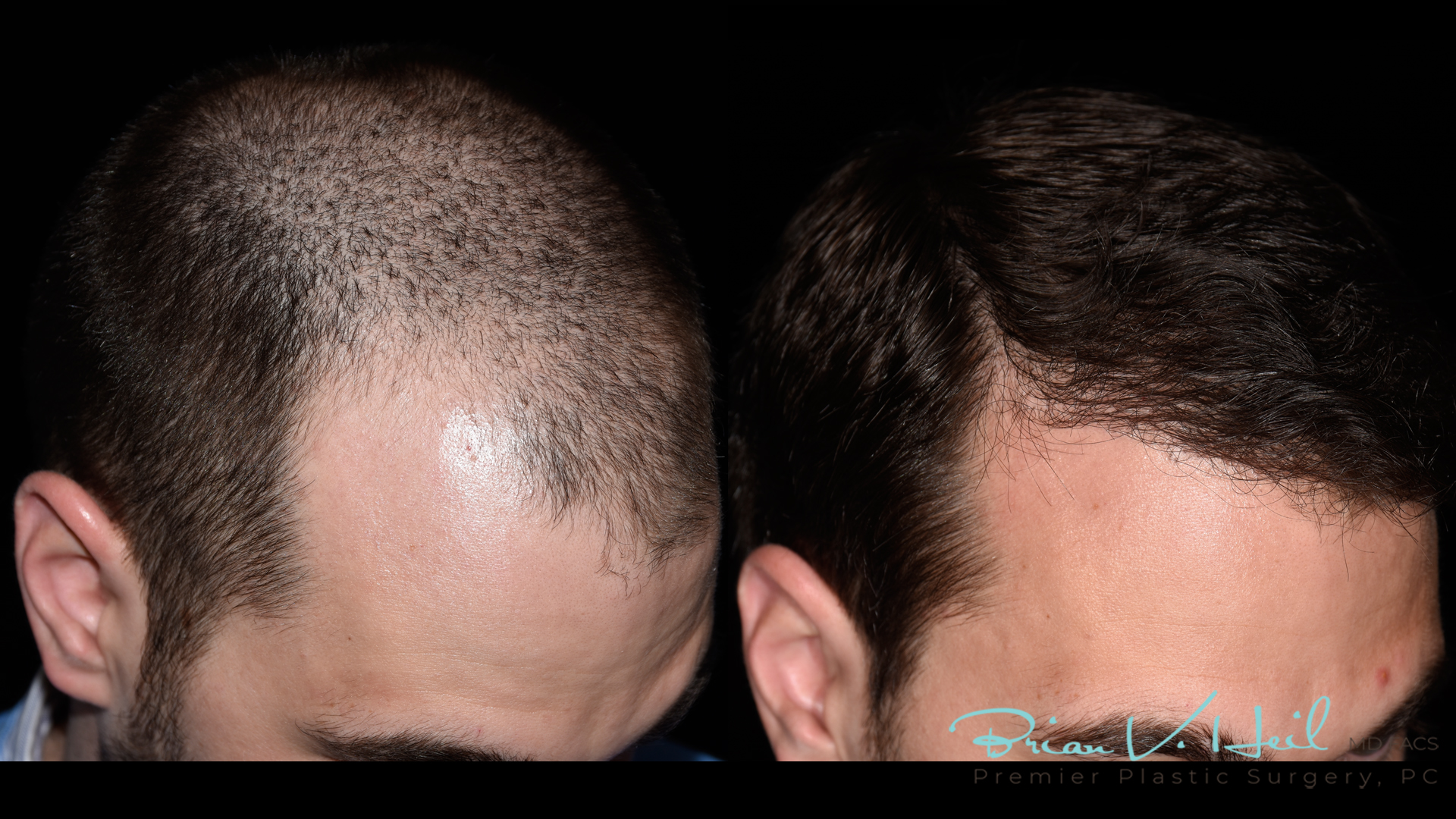 Hair Restoration Before and After | Premier Plastic Surgery