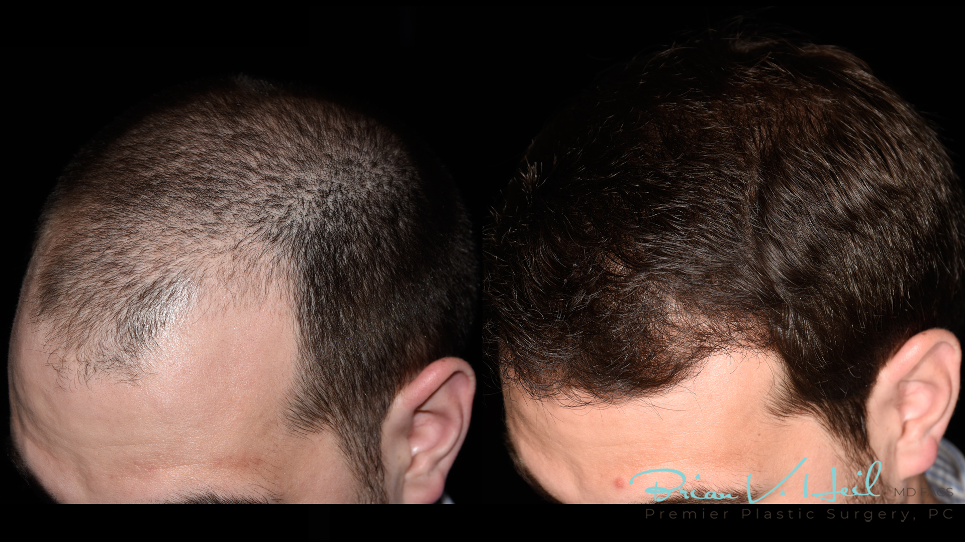 Hair Restoration Before and After | Premier Plastic Surgery