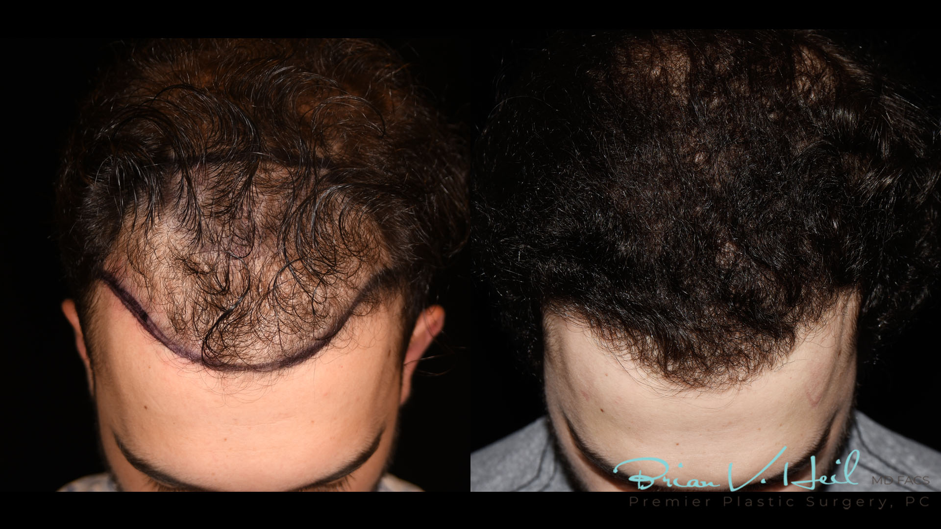 Hair Restoration Before and After | Premier Plastic Surgery