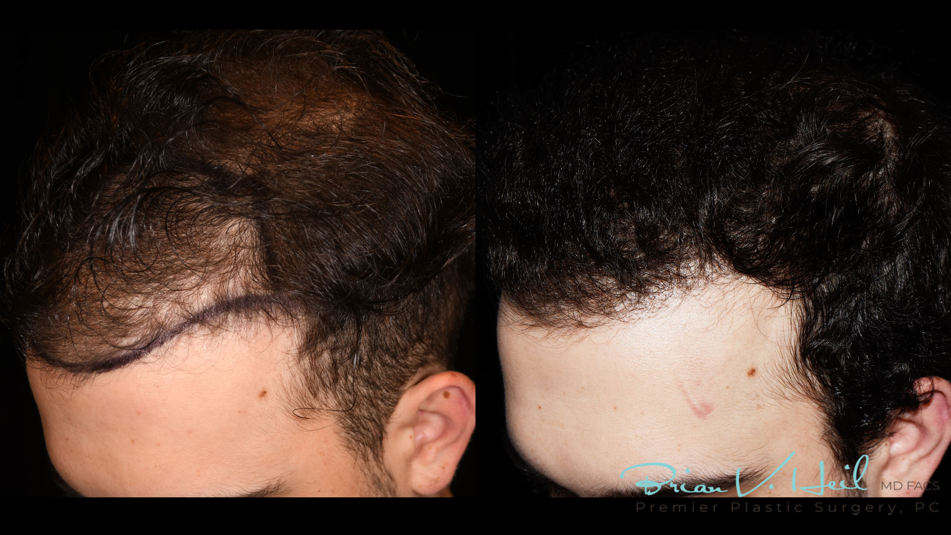 Hair Restoration Before and After | Premier Plastic Surgery