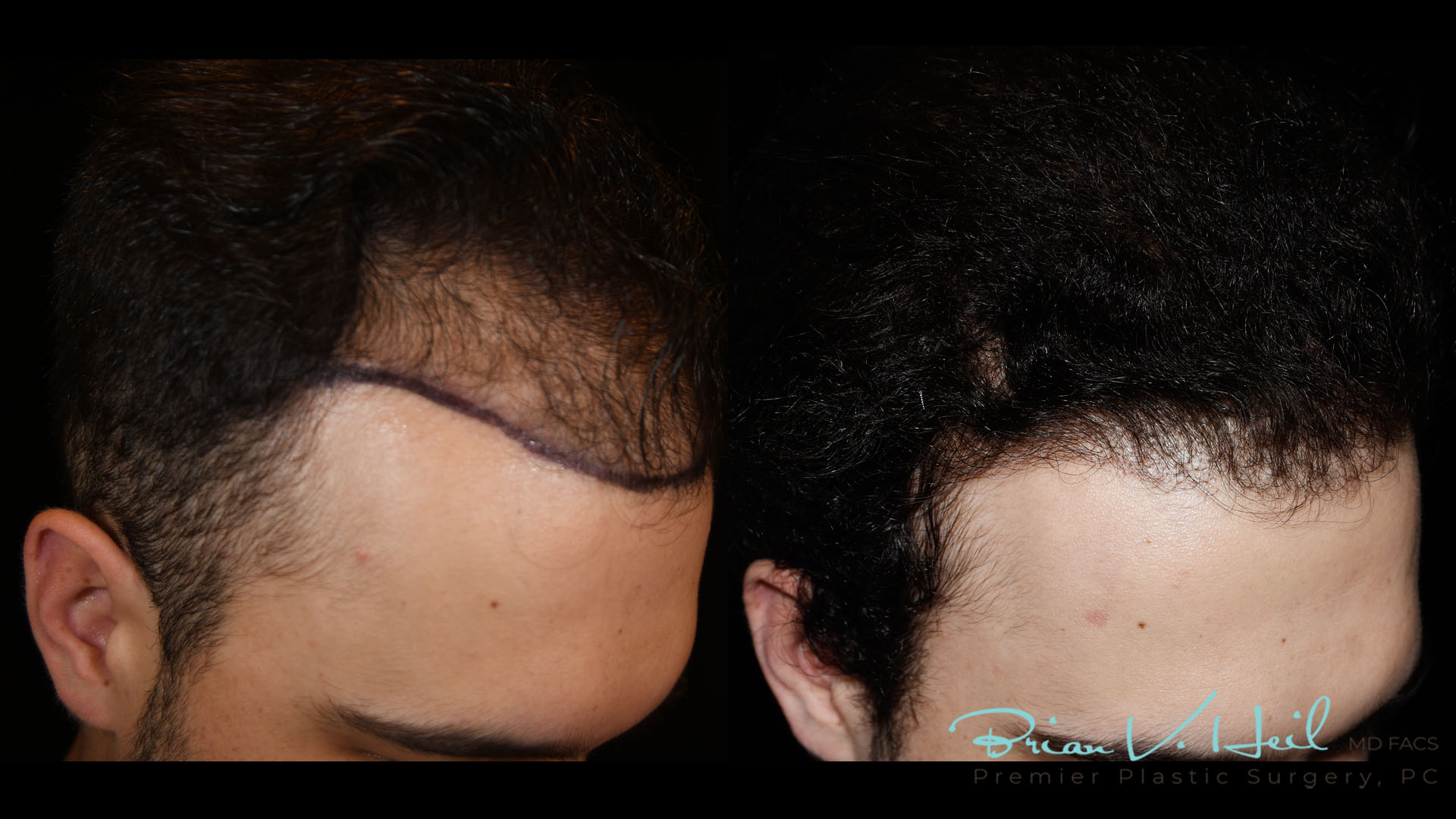 Hair Restoration Before and After | Premier Plastic Surgery