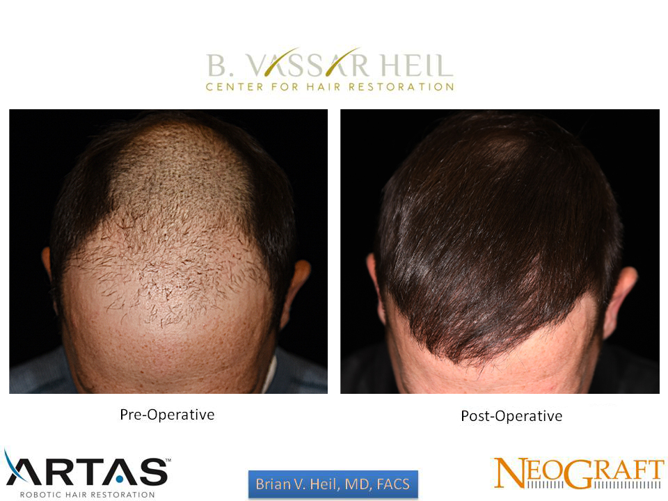 Hair Restoration Before and After | Premier Plastic Surgery