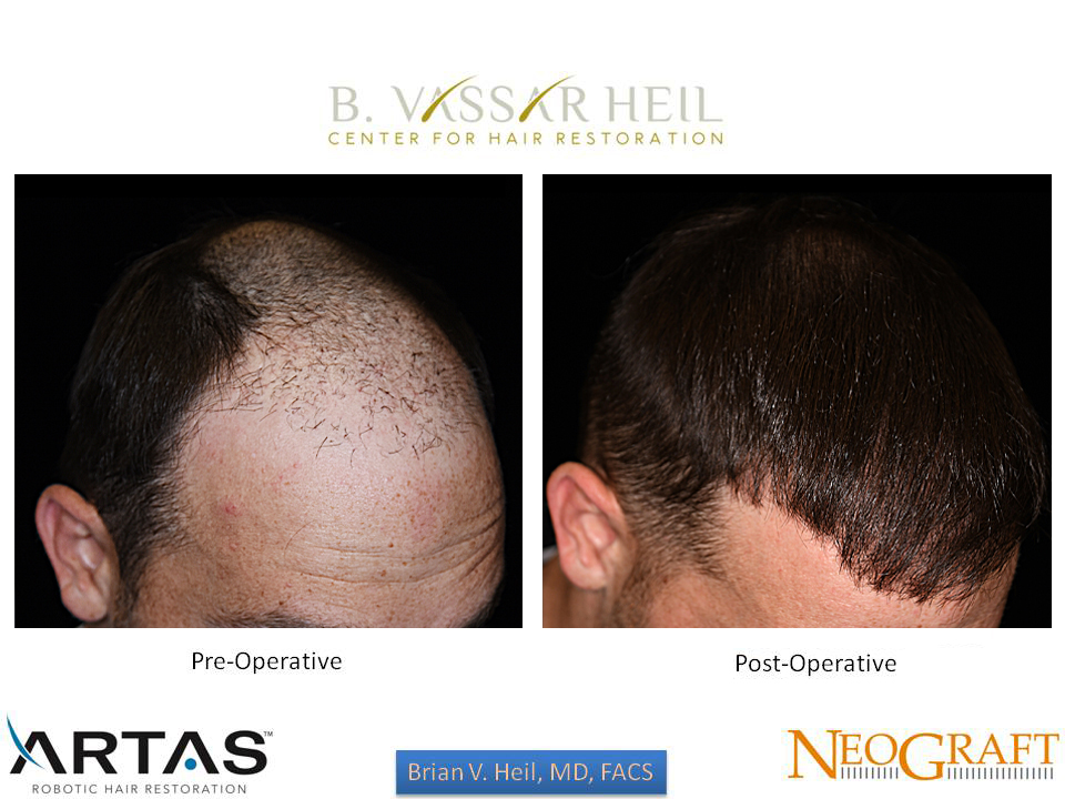 Hair Restoration Before and After | Premier Plastic Surgery