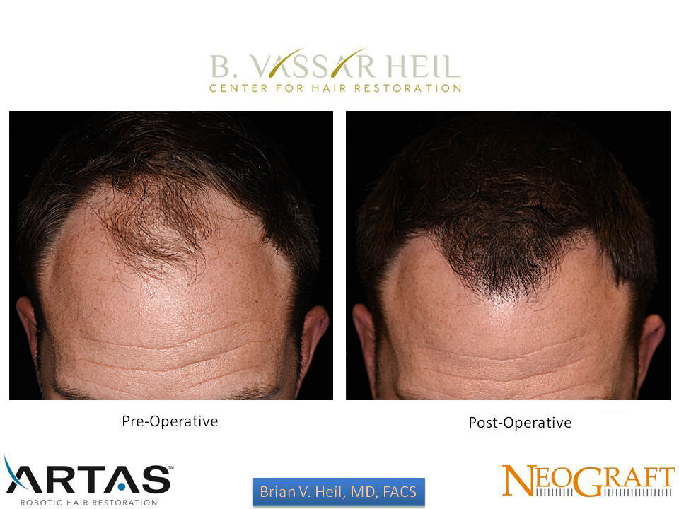 Hair Restoration Before and After | Premier Plastic Surgery