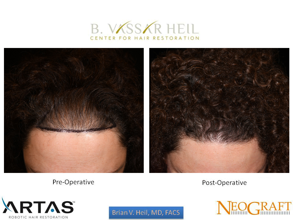 Hair Restoration Before and After | Premier Plastic Surgery