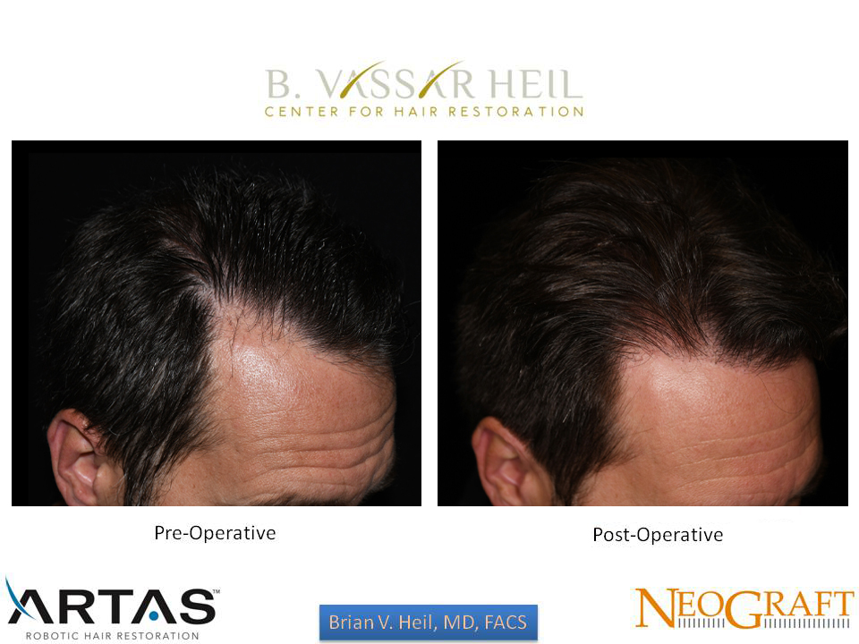 Hair Restoration Before and After | Premier Plastic Surgery