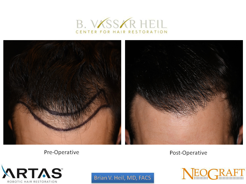 Hair Restoration Before and After | Premier Plastic Surgery