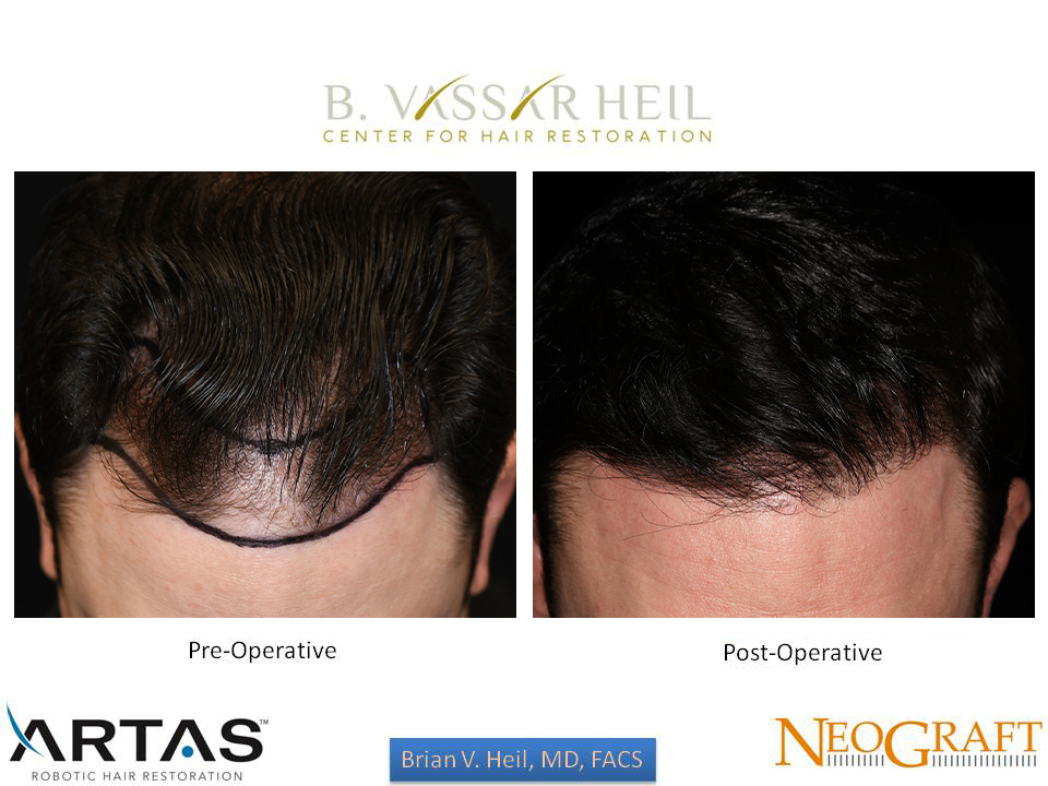 Hair Restoration Before and After | Premier Plastic Surgery