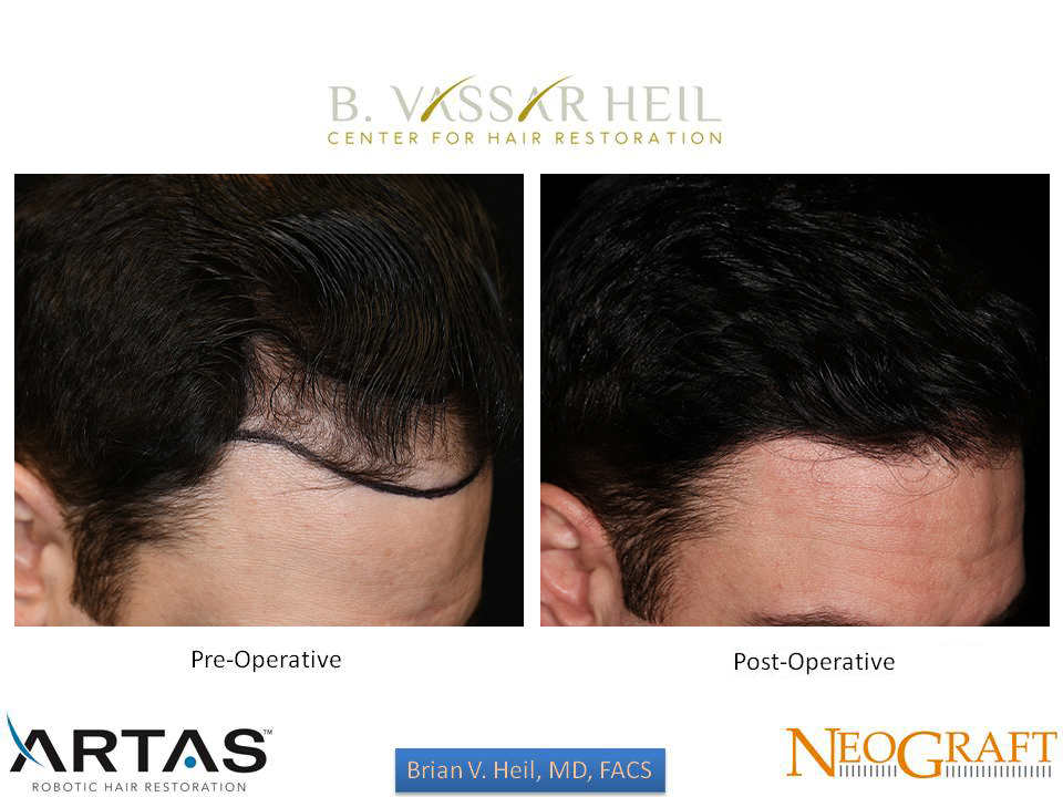 Hair Restoration Before and After | Premier Plastic Surgery