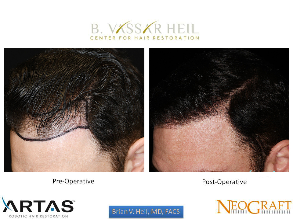 Hair Restoration Before and After | Premier Plastic Surgery