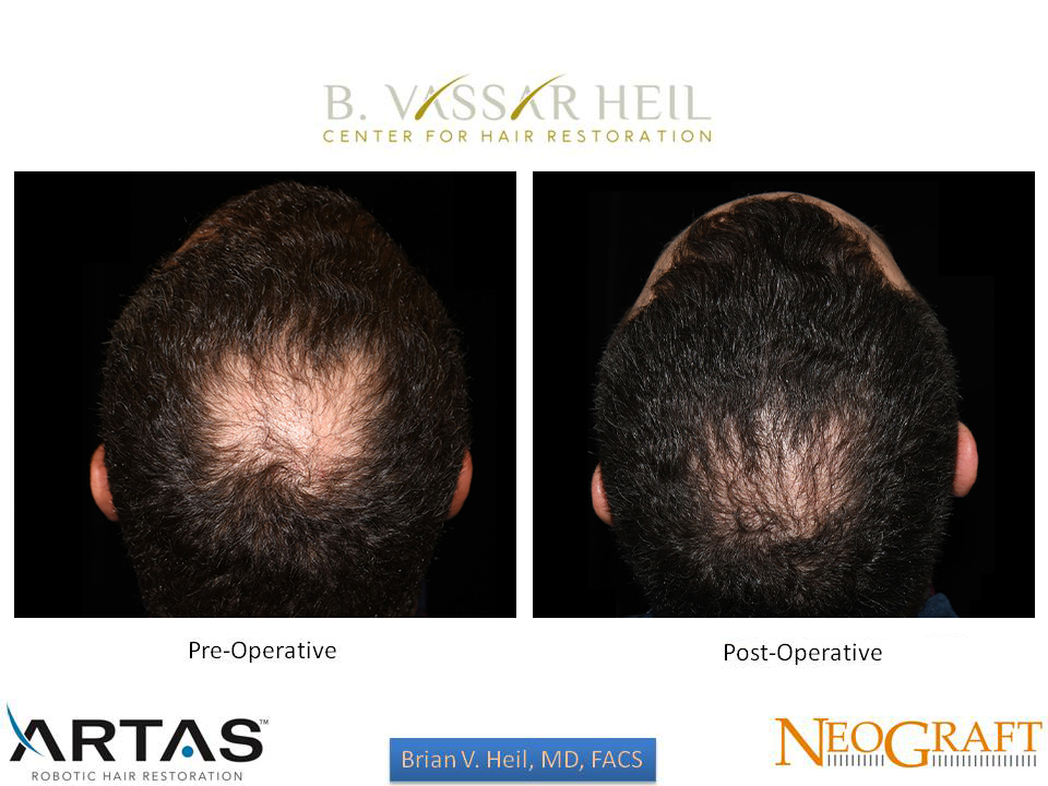 Hair Restoration Before and After | Premier Plastic Surgery