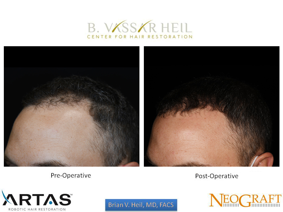 Hair Restoration Before and After | Premier Plastic Surgery