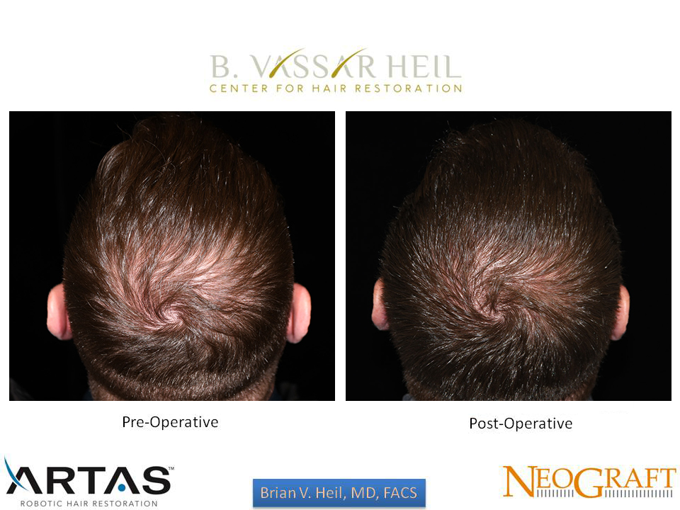 Hair Restoration Before and After | Premier Plastic Surgery