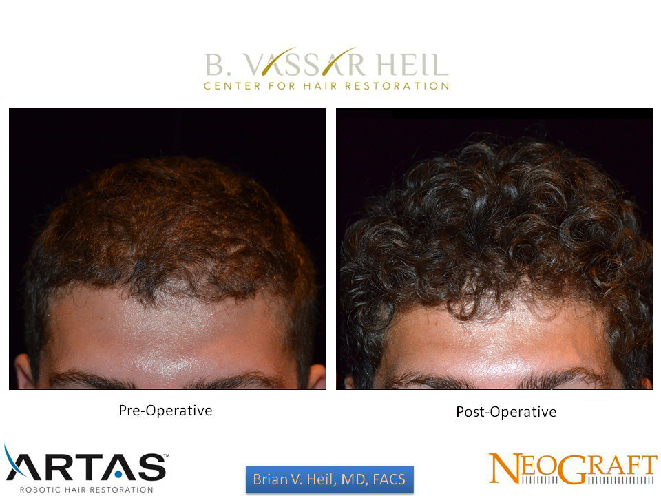 Hair Restoration Before and After | Premier Plastic Surgery