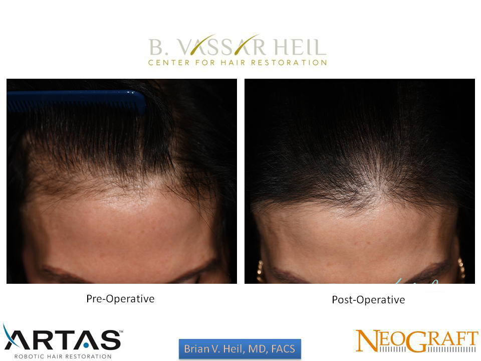 Hair Restoration Before and After | Premier Plastic Surgery