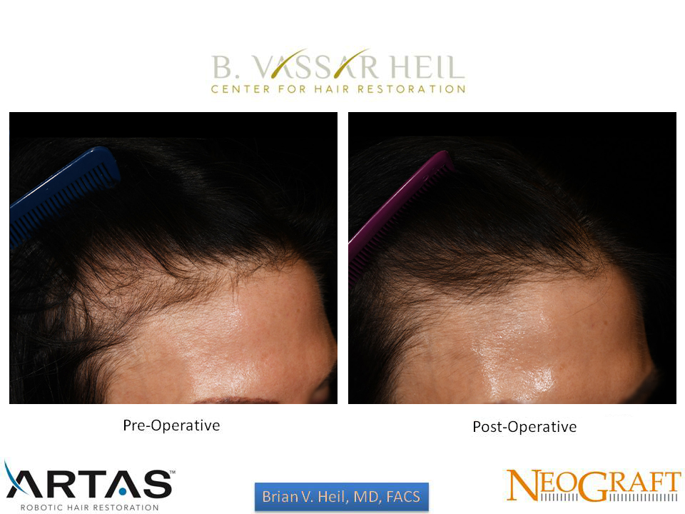 Hair Restoration Before and After | Premier Plastic Surgery