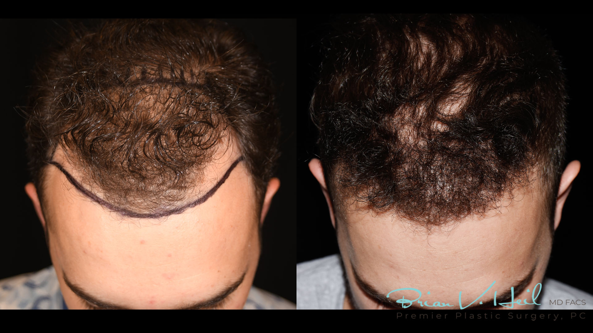 Hair Restoration Before and After | Premier Plastic Surgery