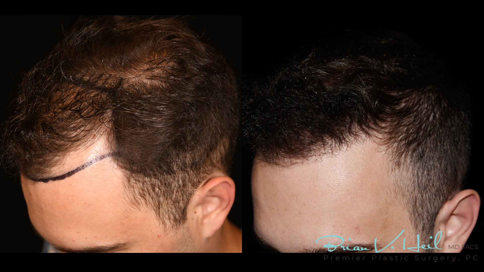 Hair Restoration Before and After | Premier Plastic Surgery