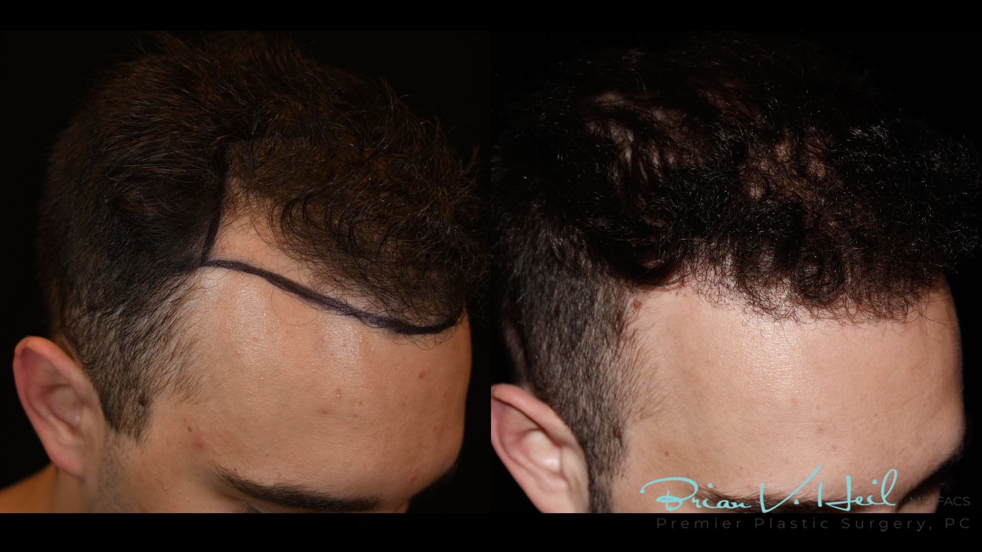 Hair Restoration Before and After | Premier Plastic Surgery