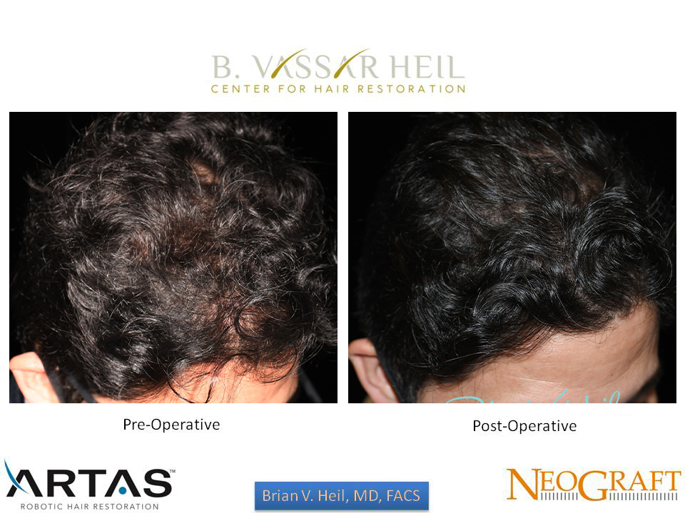 Hair Restoration Before and After | Premier Plastic Surgery