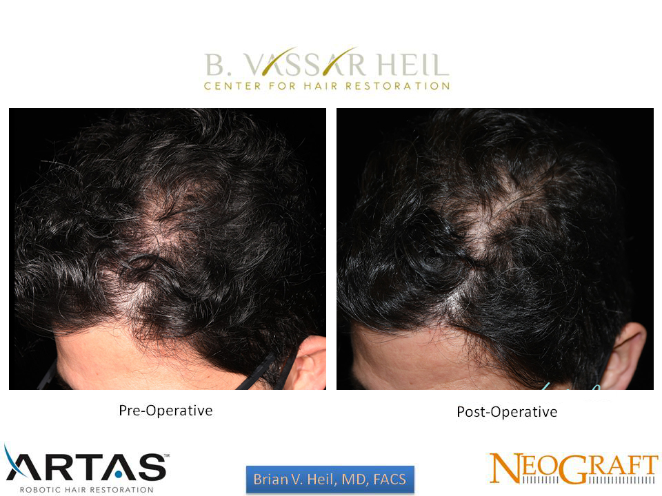 Hair Restoration Before and After | Premier Plastic Surgery