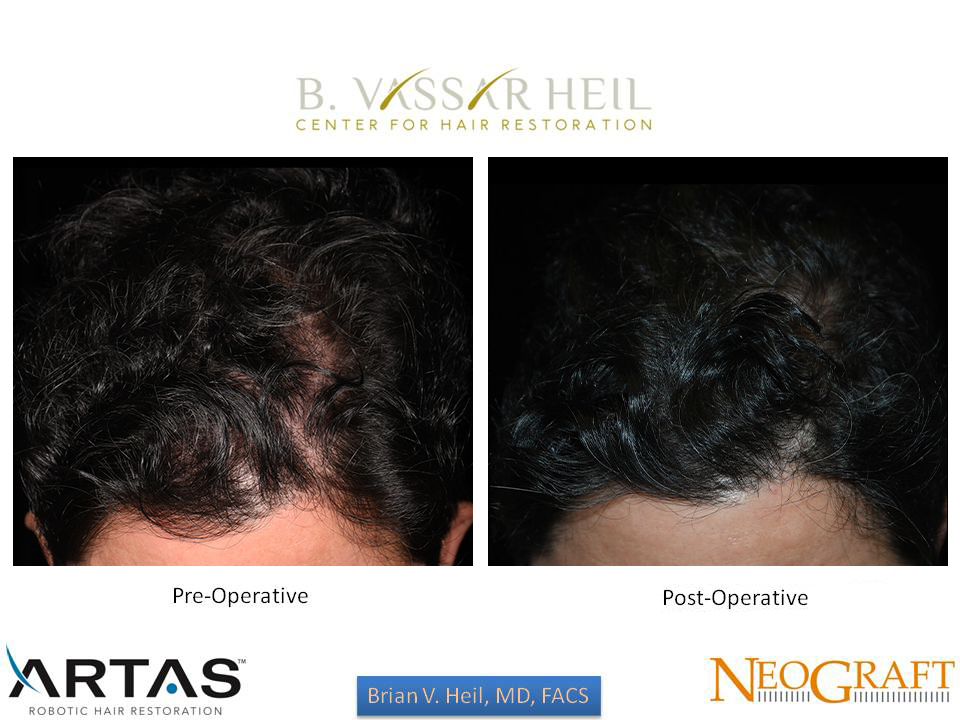 Hair Restoration Before and After | Premier Plastic Surgery