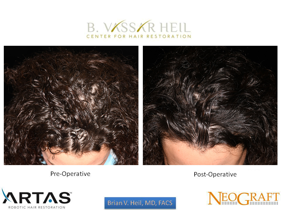 Hair Restoration Before and After | Premier Plastic Surgery