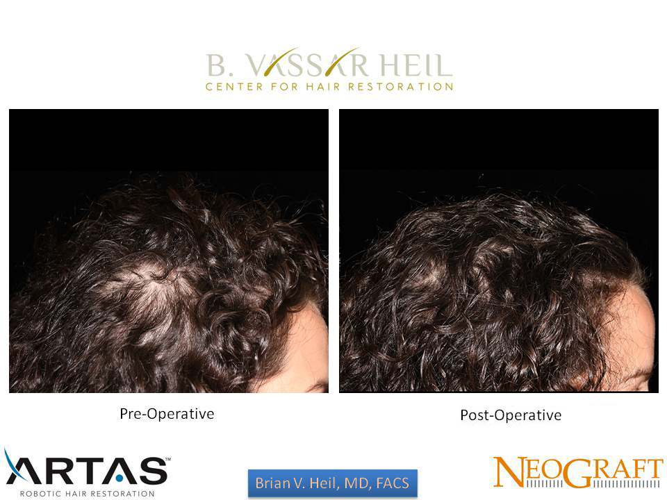 Hair Restoration Before and After | Premier Plastic Surgery