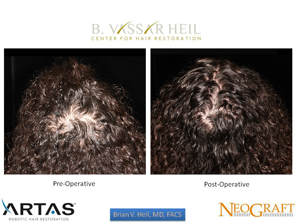 Hair Restoration Before and After | Premier Plastic Surgery