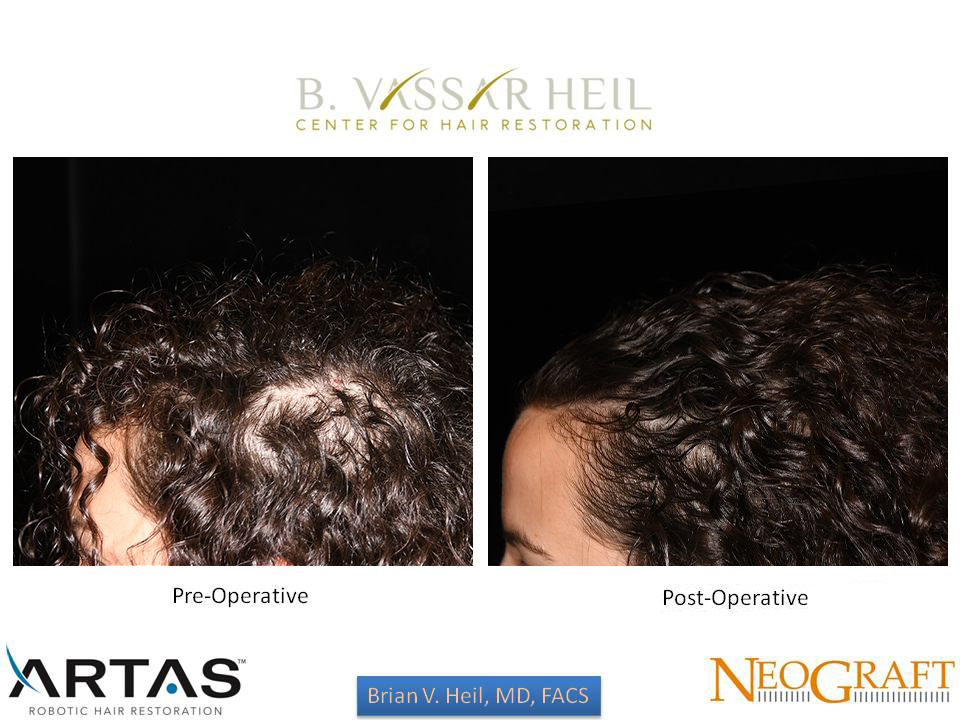 Hair Restoration Before and After | Premier Plastic Surgery