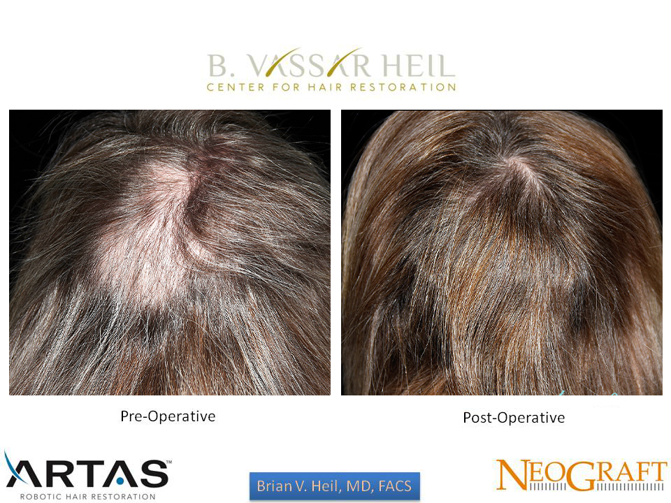 Hair Restoration Before and After | Premier Plastic Surgery