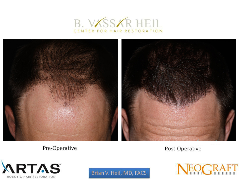 Hair Restoration Before and After | Premier Plastic Surgery