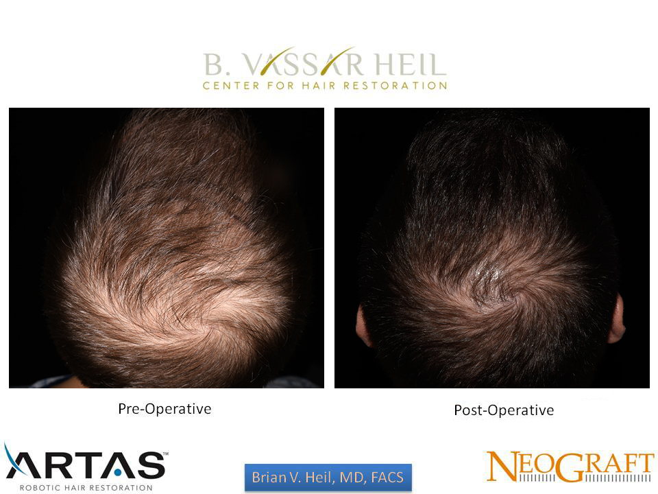 Hair Restoration Before and After | Premier Plastic Surgery