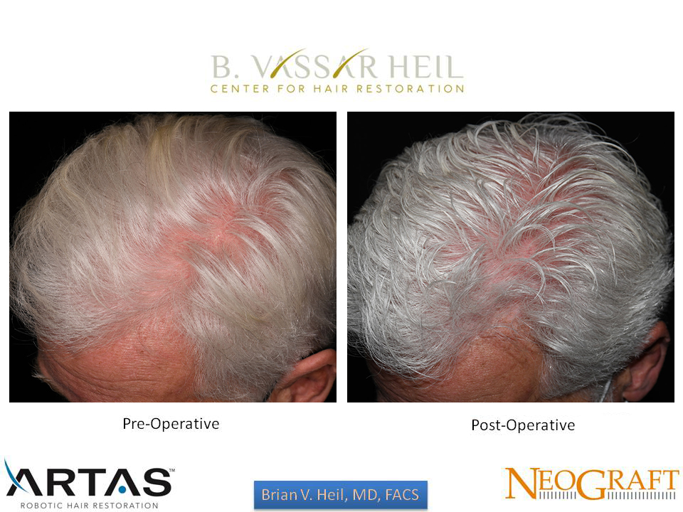 Hair Restoration Before and After | Premier Plastic Surgery