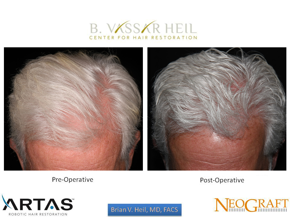 Hair Restoration Before and After | Premier Plastic Surgery