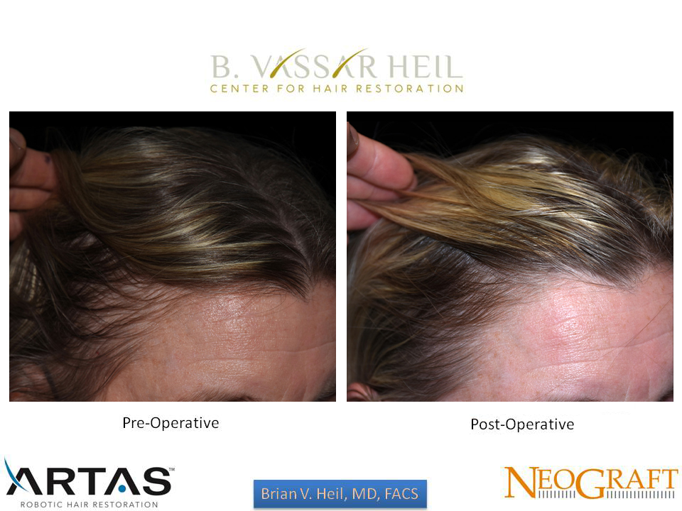 Hair Restoration Before and After | Premier Plastic Surgery