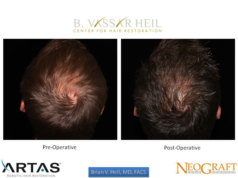 Hair Restoration Before and After | Premier Plastic Surgery