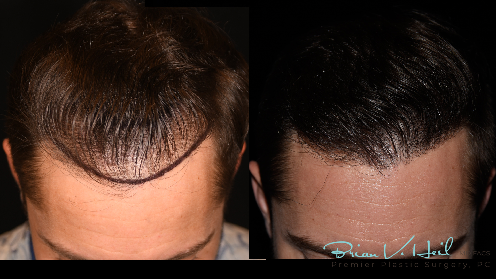 Hair Restoration Before and After | Premier Plastic Surgery