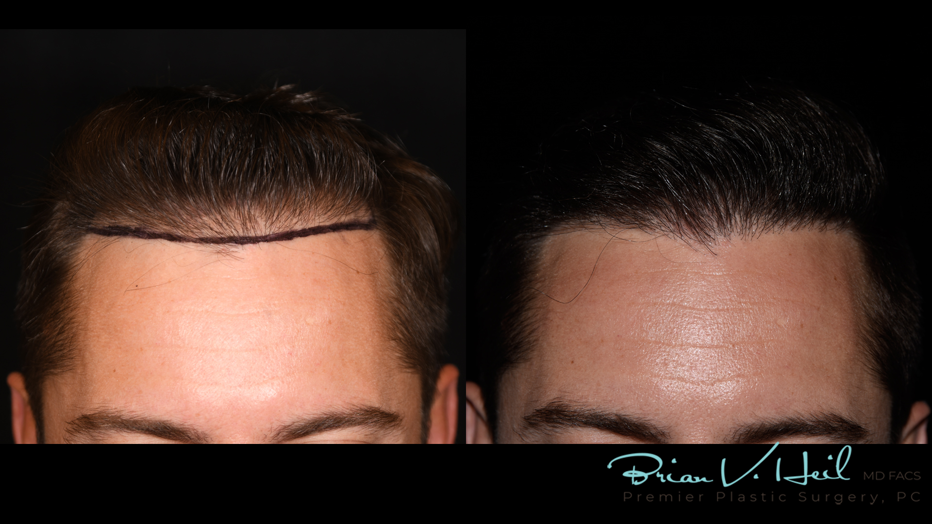 Hair Restoration Before and After | Premier Plastic Surgery