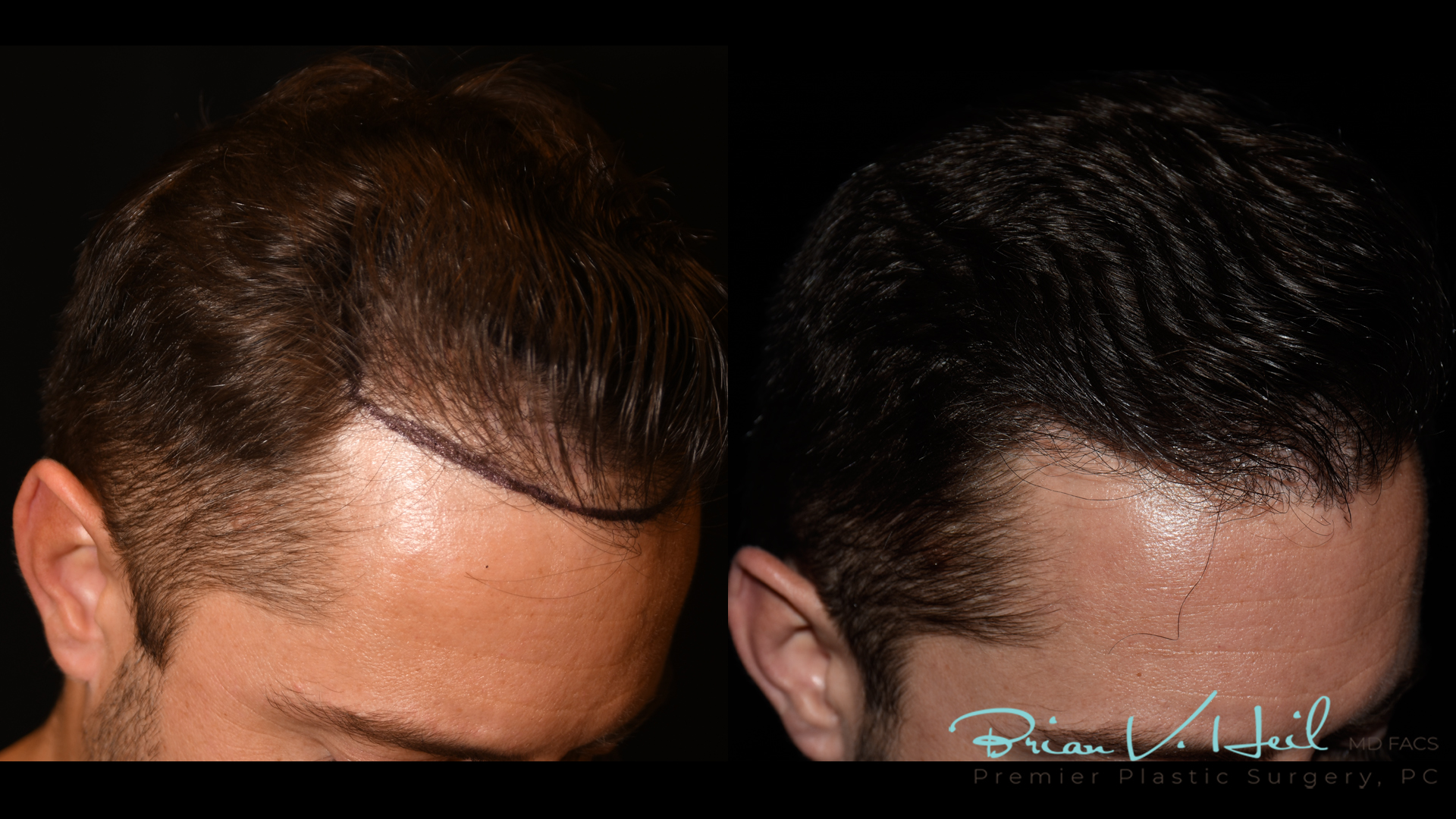 Hair Restoration Before and After | Premier Plastic Surgery