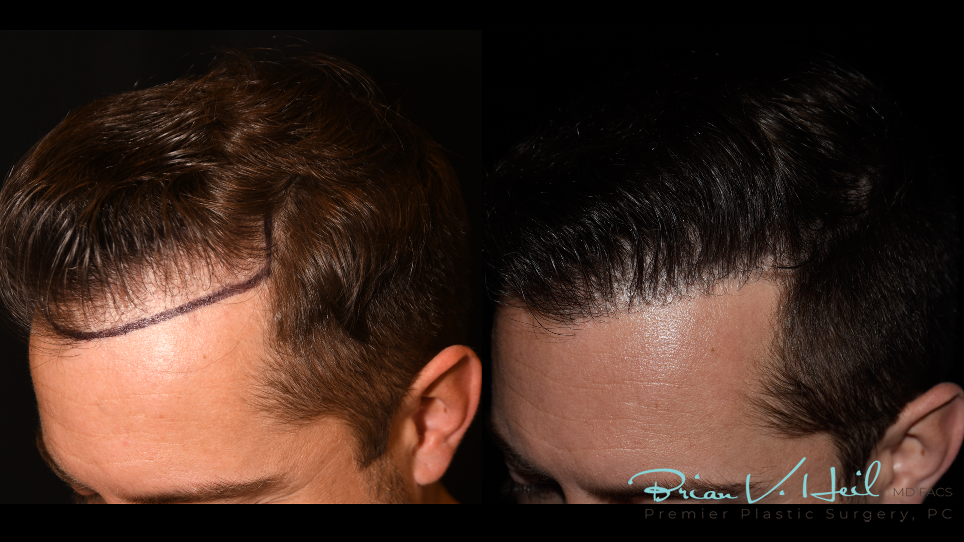 Hair Restoration Before and After | Premier Plastic Surgery