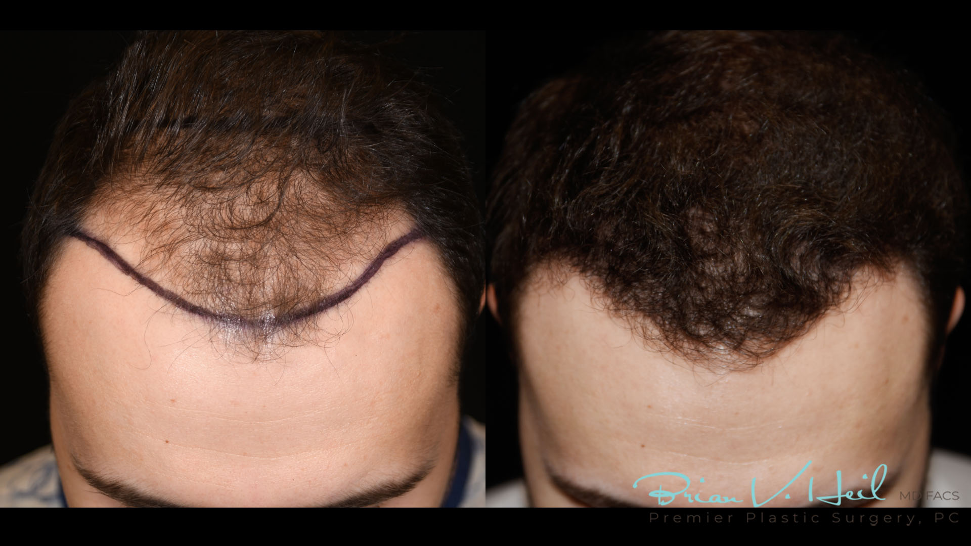 Hair Restoration Before and After | Premier Plastic Surgery