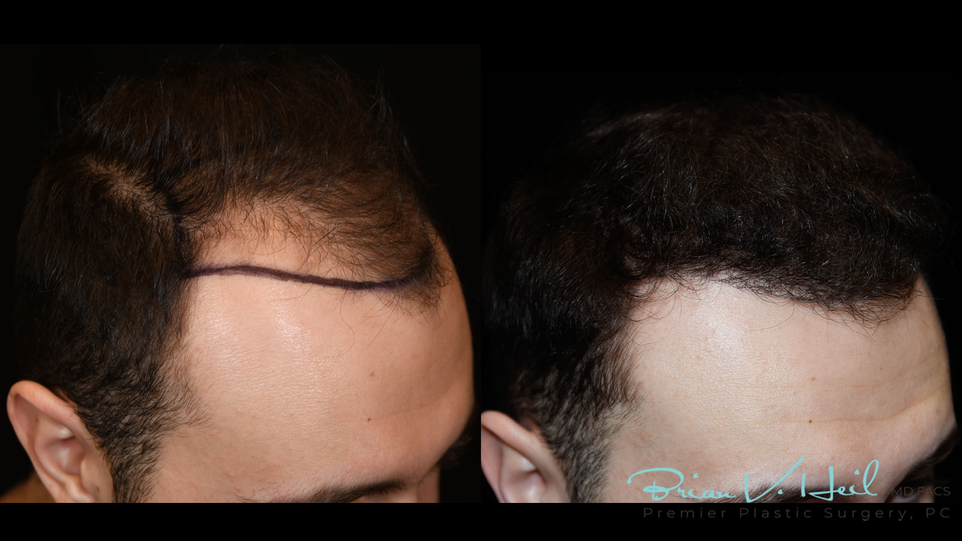 Hair Restoration Before and After | Premier Plastic Surgery